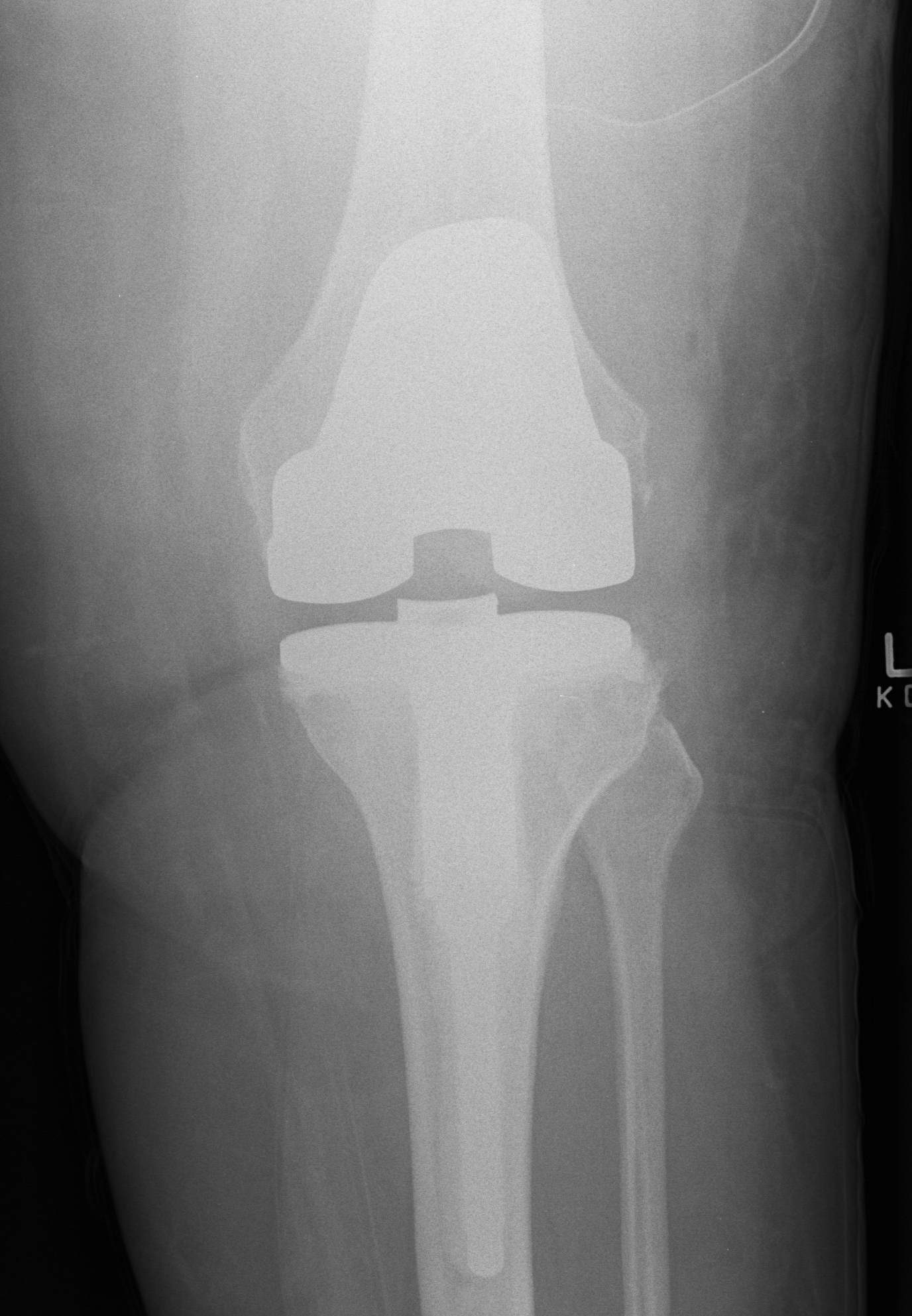 Revision TKR Type 1 Defect